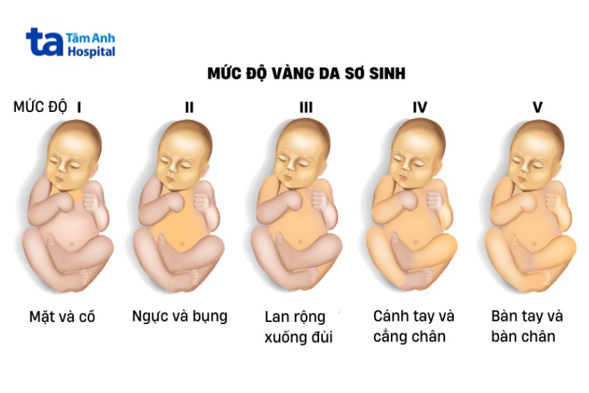 Vàng da sơ sinh được chia làm 5 mức độ theo Kramer