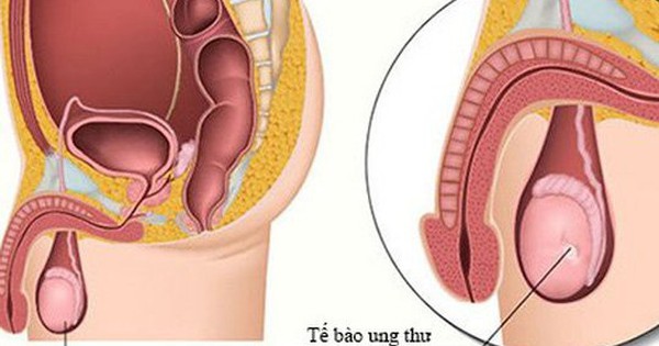 Bé trai 11 tuổi đã mắc ung thư tinh hoàn, chuyên gia cảnh báo dấu hiệu bệnh