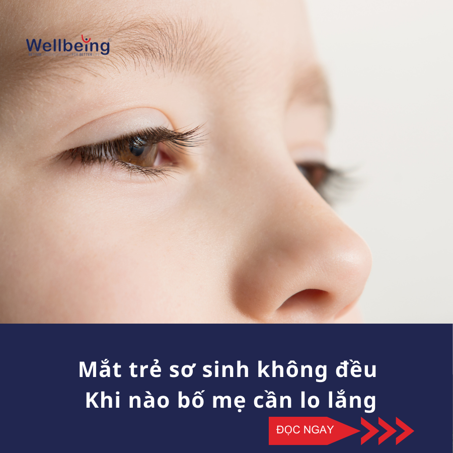 Mắt trẻ sơ sinh không đều- Khi nào bố mẹ cần lo lắng| Wellbeing